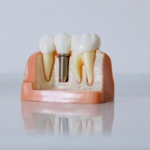 ¡Vuelve a sonreír! Implante Dental de Titanio