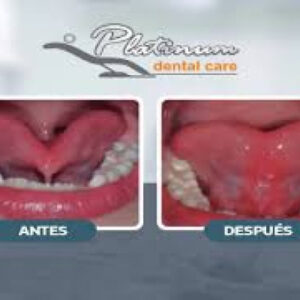 ¡Cirugía de frenillo lingual de 7 años a más! en Platinum Dental